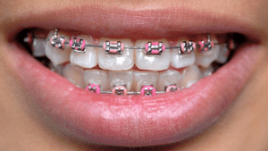 Types of Braces Carlsbad CA  Hurst Orthodontics Invisalign