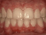 After treatment at Hurst Orthodontics in Carlsbad, CA