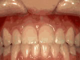 Openbite after picture Hurst Orthodontics in Carlsbad, CA