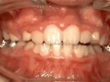 After picture Hurst Orthodontics in Carlsbad, CA