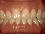 Spacing teeth after Hurst Orthodontics in Carlsbad, CA