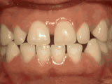 Spacing teeth Hurst Orthodontics in Carlsbad, CA