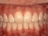 overbite after
